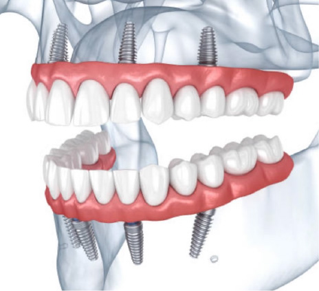 インプラントの装着時の上下の歯の画像